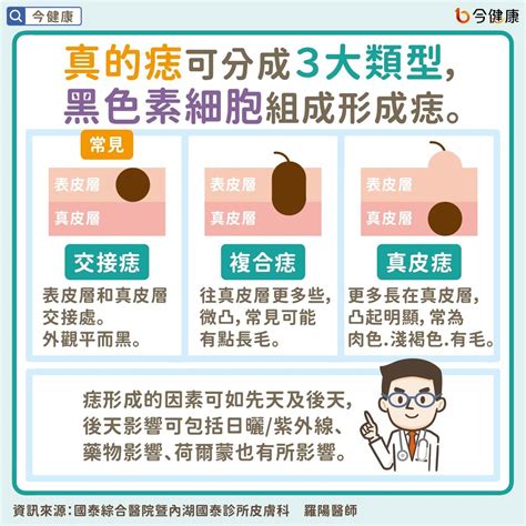 痣長毛|是痣or皮膚癌？醫「1張圖秒對照」 長這2部位最危險